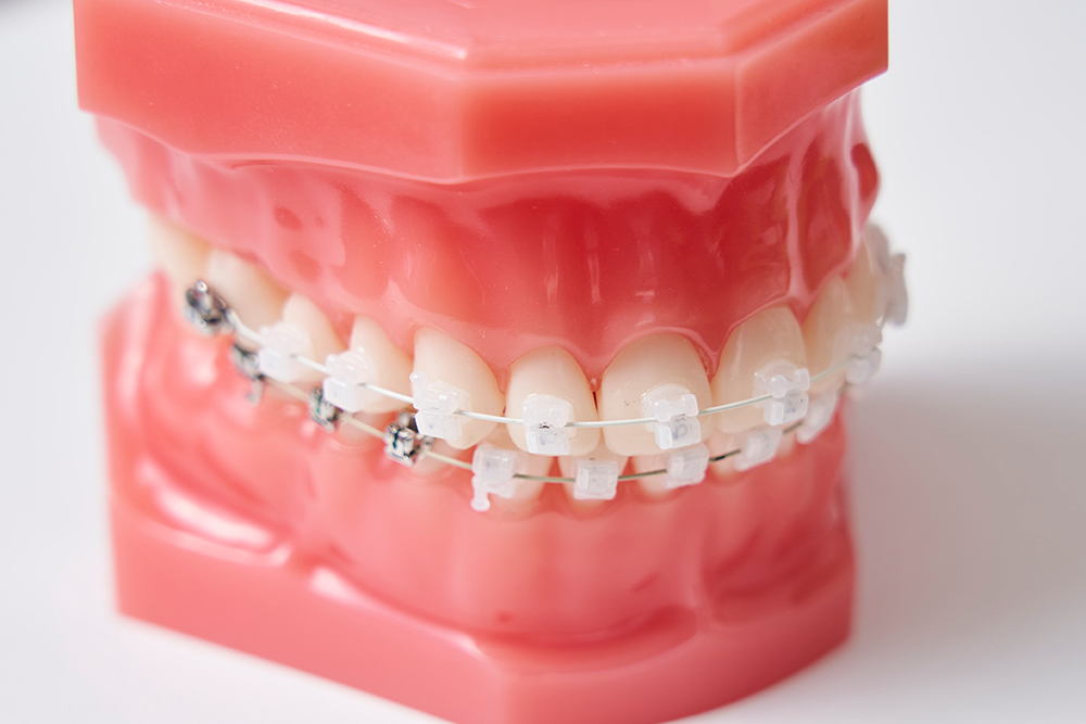 目立たない・見えにくい矯正装置をご用意