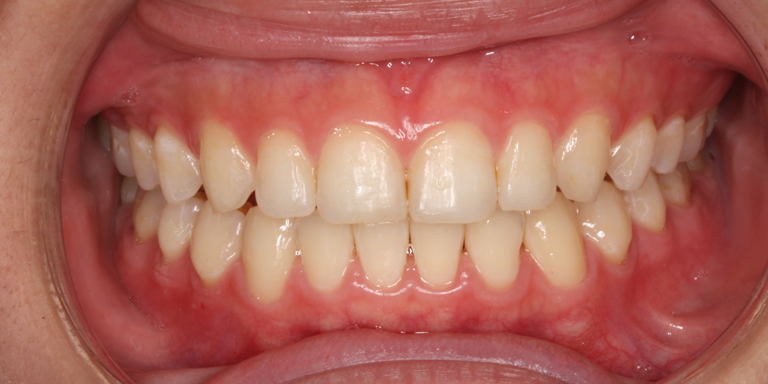 ホワイトニング症例