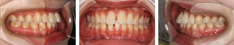 すきっ歯　治療前