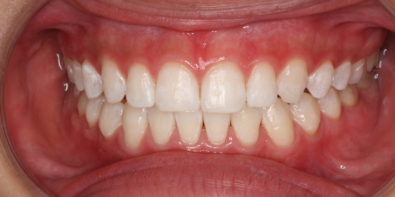 ホワイトニング症例