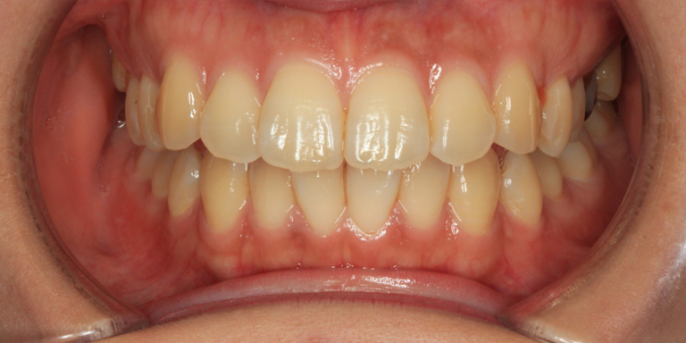 ホワイトニング症例