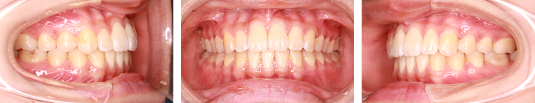 すきっ歯　治療後