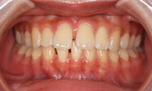 出っ歯、すきっ歯:治療前