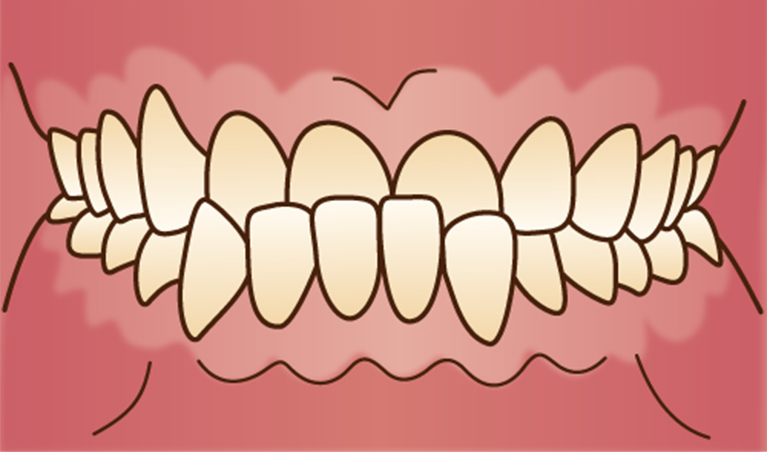 受け口で悩んでいる……
