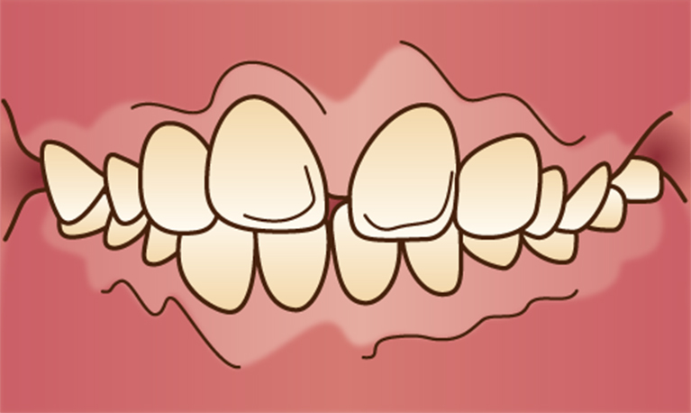 出っ歯が気になって……